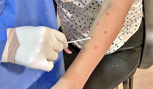 IMPARTIRÁN&nbsp;UNA NUEVA CAPACITACIÓN MÉDICA PARA DETECCIÓN Y MANEJO DE MPOXEN BCS&nbsp;(#ViruelaSimica)