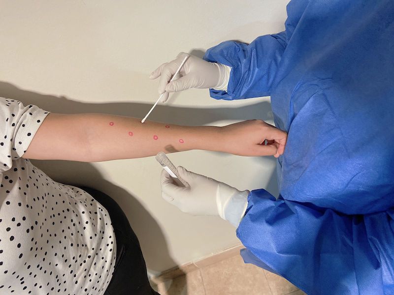 CONFIRMA SALUD ESTATAL UN CASO DE VIRUELA SÍMICA NO&nbsp;GRAVE