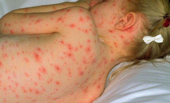 Atiende con éxito Hospital General del ISSSTE Querétaro a menor con caso grave de&nbsp;varicela